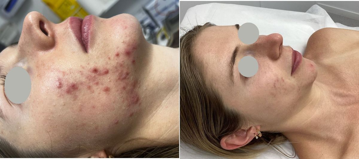 Before and after acne treatment with HydraFacial and Dermapen 4 microneedling