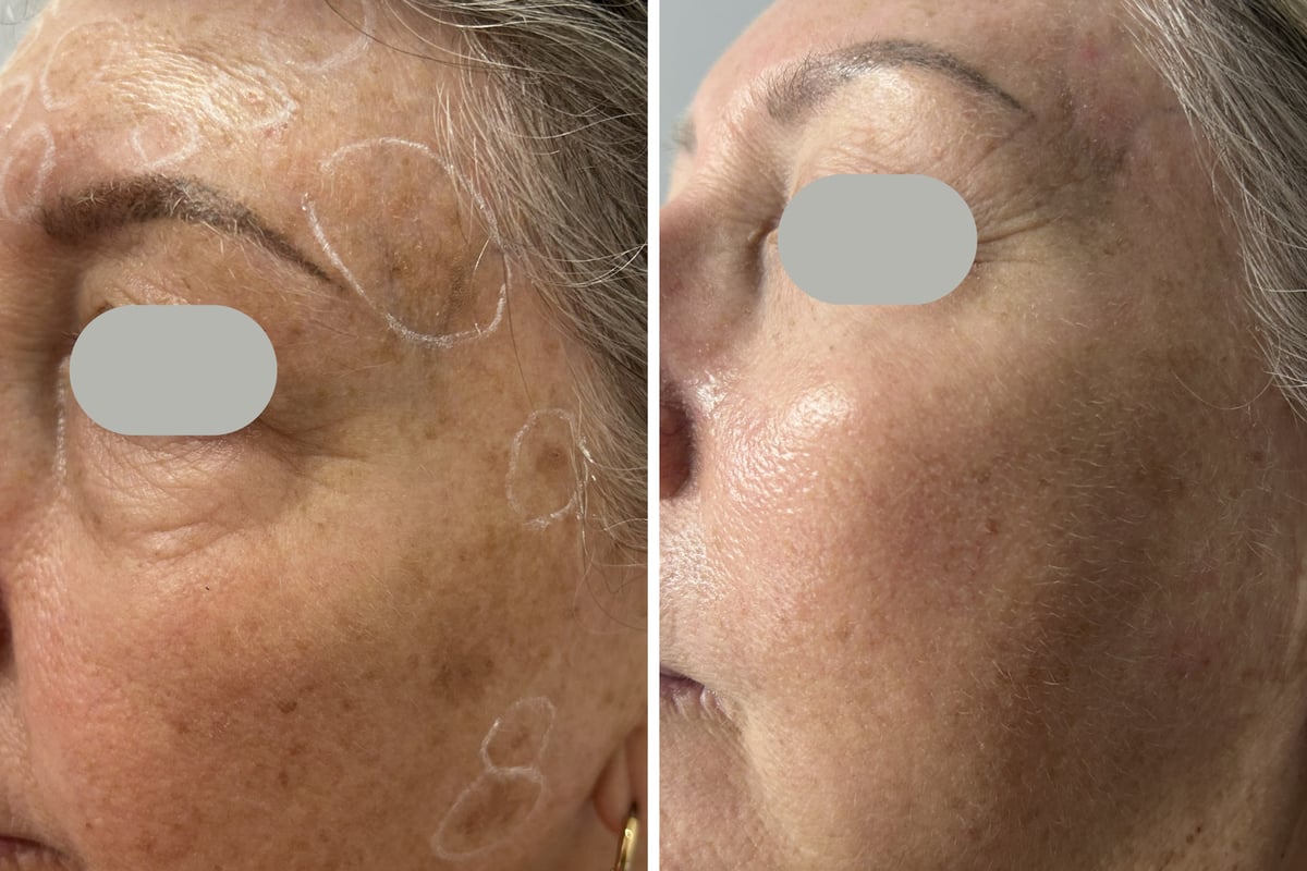 Before and after CO2 laser removal of multiple benign keratoses — left side view
