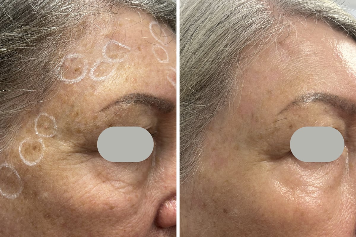 Before and after CO2 laser removal of multiple benign keratoses — right side view