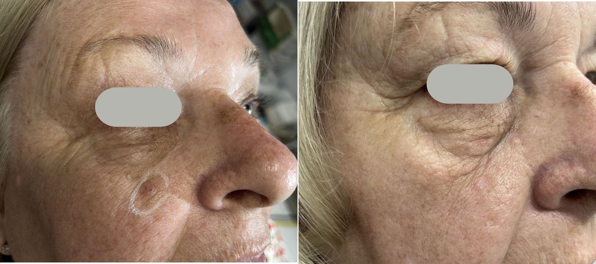 Before and after CO2 laser removal of benign keratoses