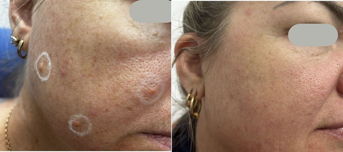 Before and after CO2 laser removal of benign intradermal nevi