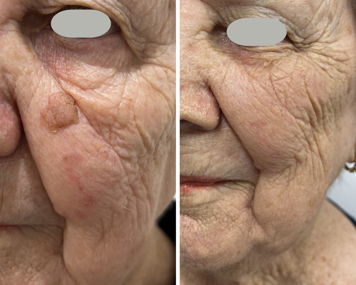 Before and after CO2 laser removal of a large cheek lesion
