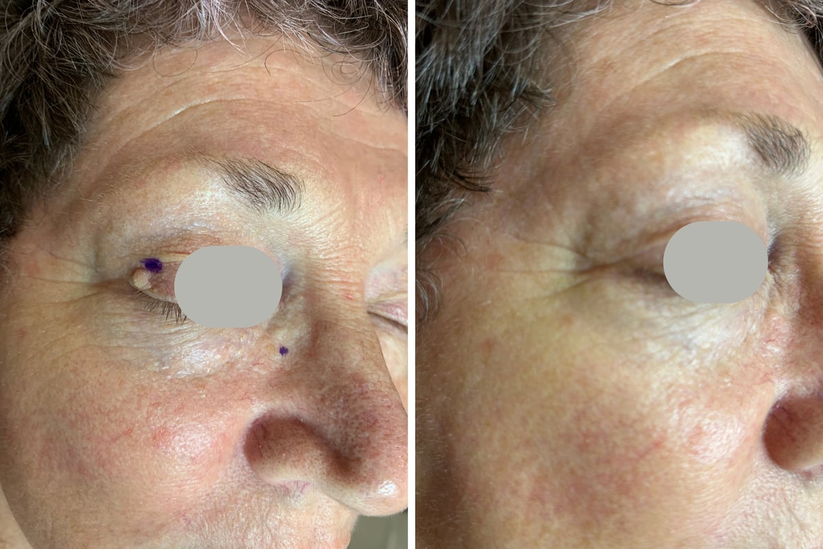 Before and after CO2 laser removal of small lesions near the eye and nose