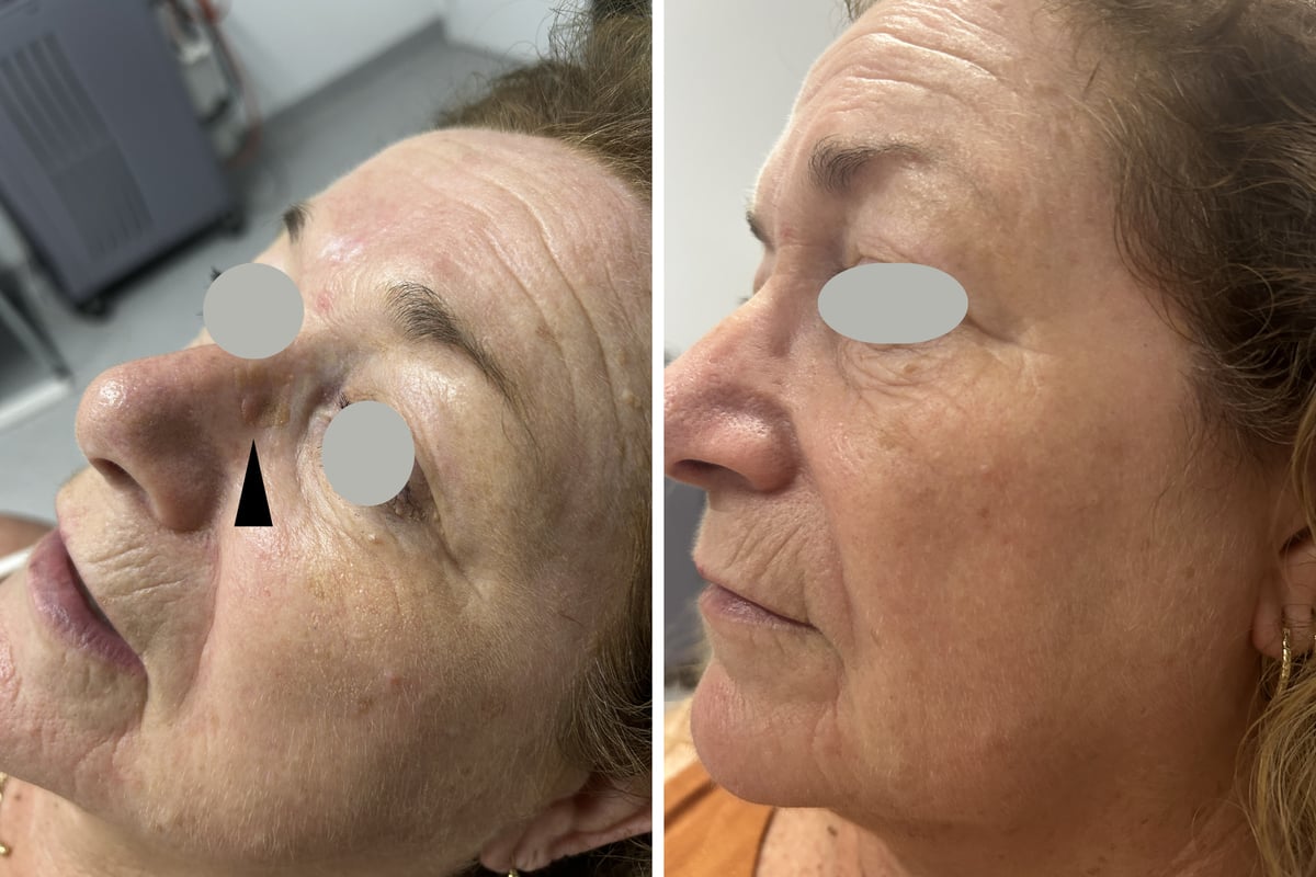 Before and after CO2 laser removal of a seborrheic keratosis on the side of the nose