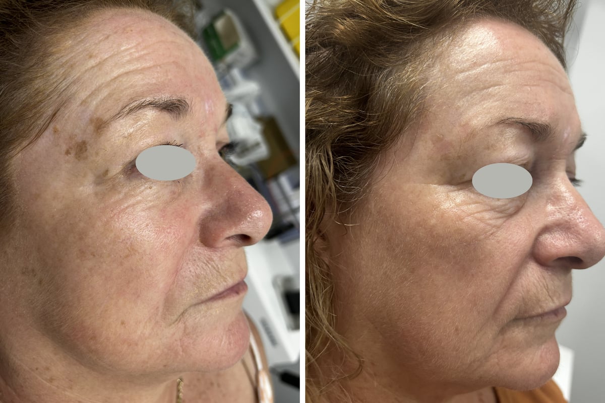 Before and after CO2 laser removal of a seborrheic keratosis on the right temple