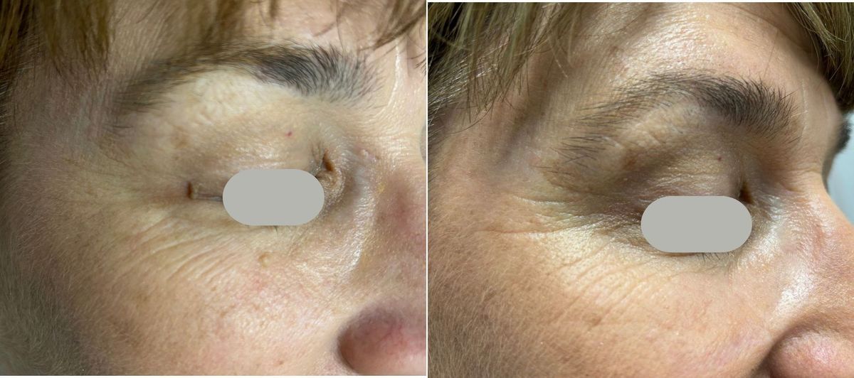 Before and after Dual Yellow laser removal of skin tags