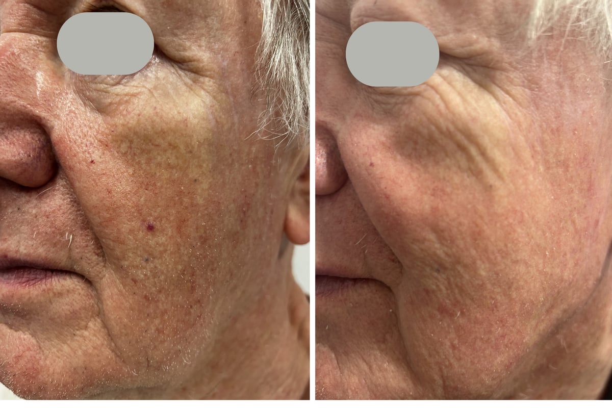 Before and after Dual Yellow laser treatment of a vascular lesion