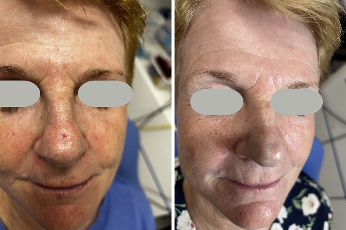 Before and after Dual Yellow laser treatment of a small vascular lesion