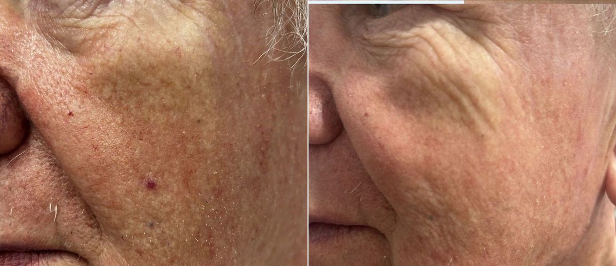 Before and after Dual Yellow laser treatment of a small vascular lesion