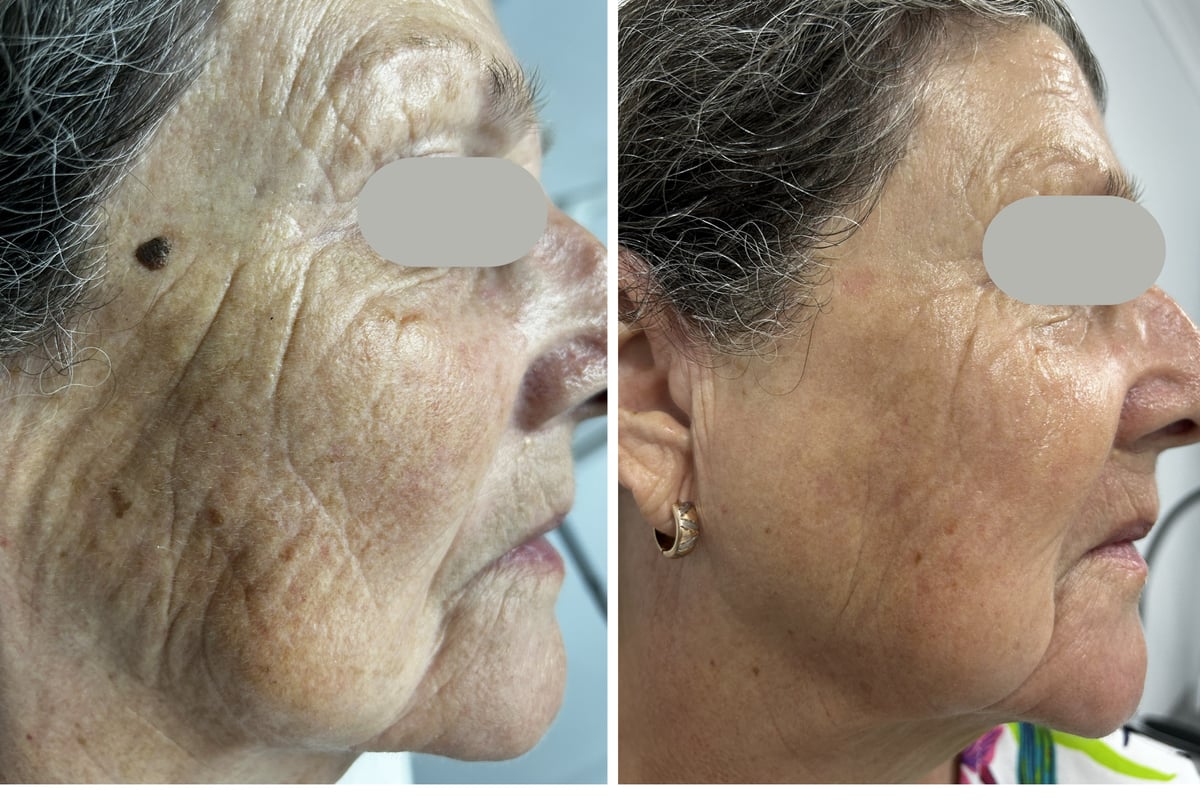 Before and after Pixel fractional resurfacing