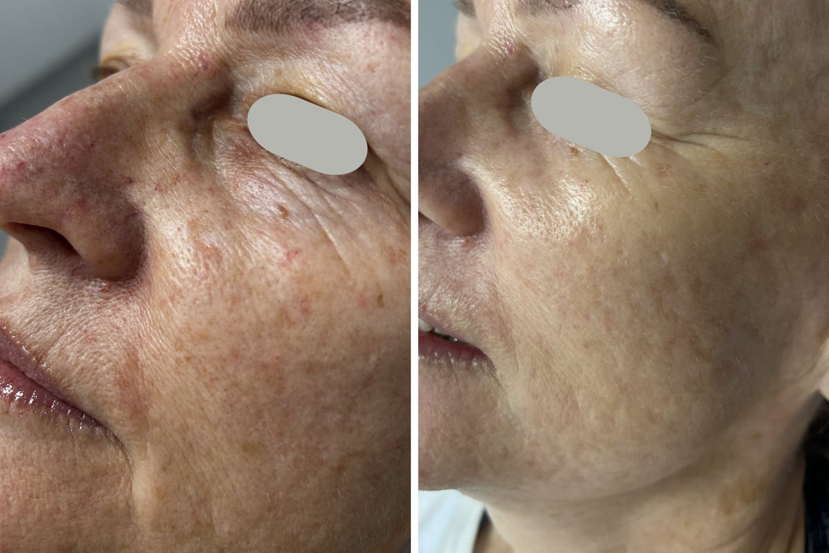 Before and after RevLite laser facial rejuvenation