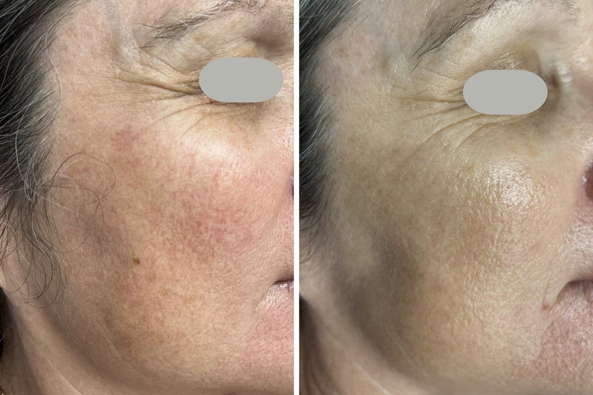 Before and after RevLite laser facial rejuvenation for sun damage