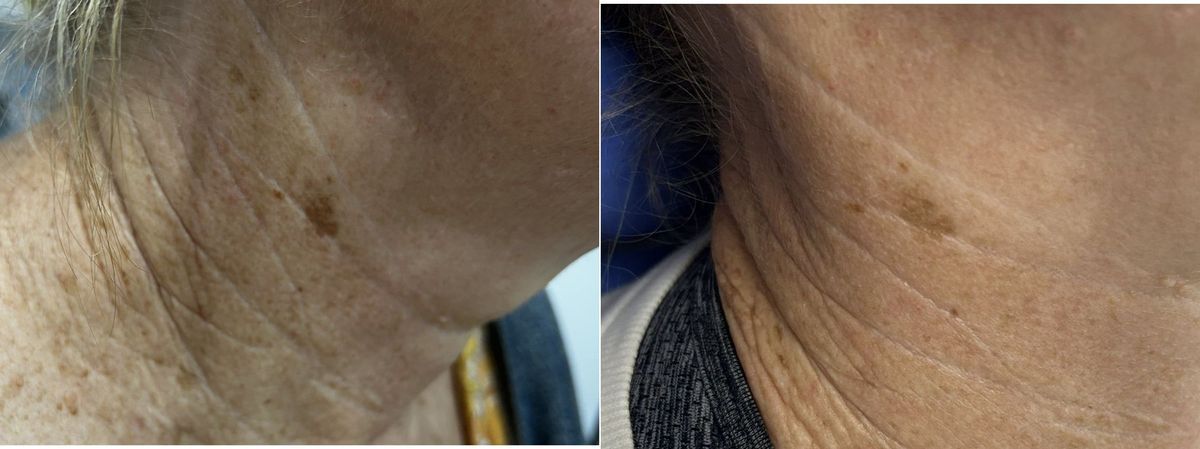 Before and after RevLite laser neck rejuvenation