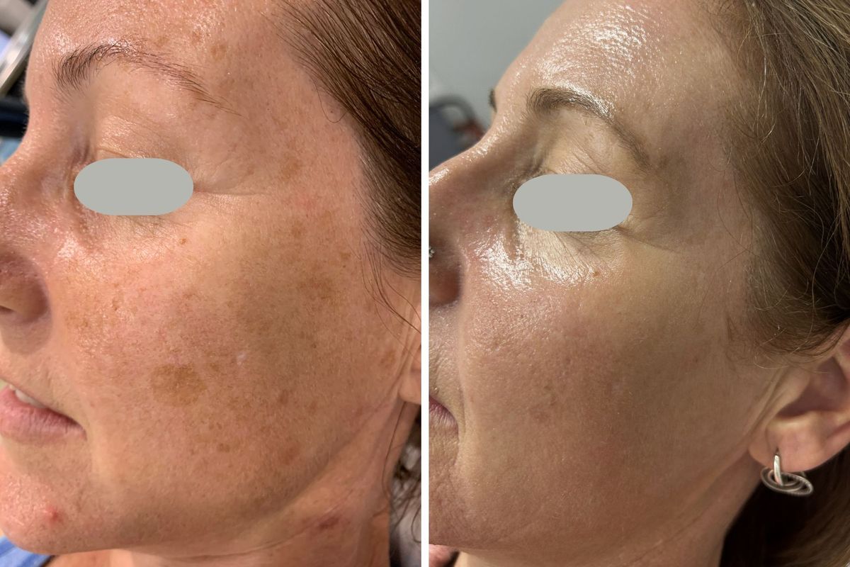 Before and after 4 sessions of RevLite laser treatment for pigmentation