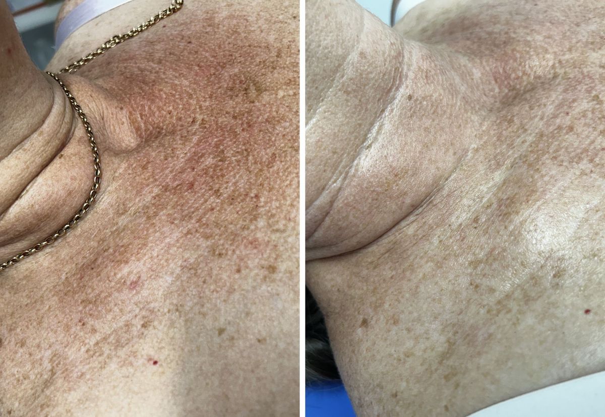 Before and after RevLite laser treatment of poikiloderma on the decolletage