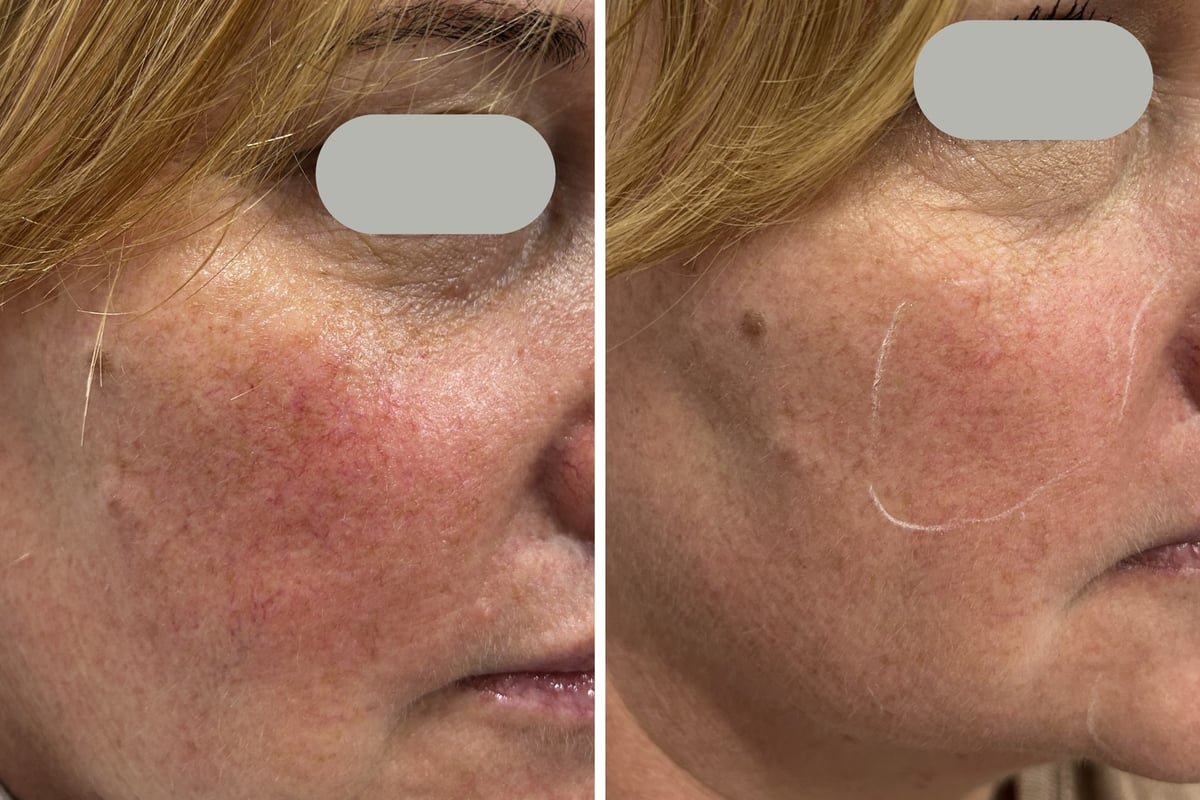 Before and after Dual Yellow laser treatment for rosacea — cheek redness cleared