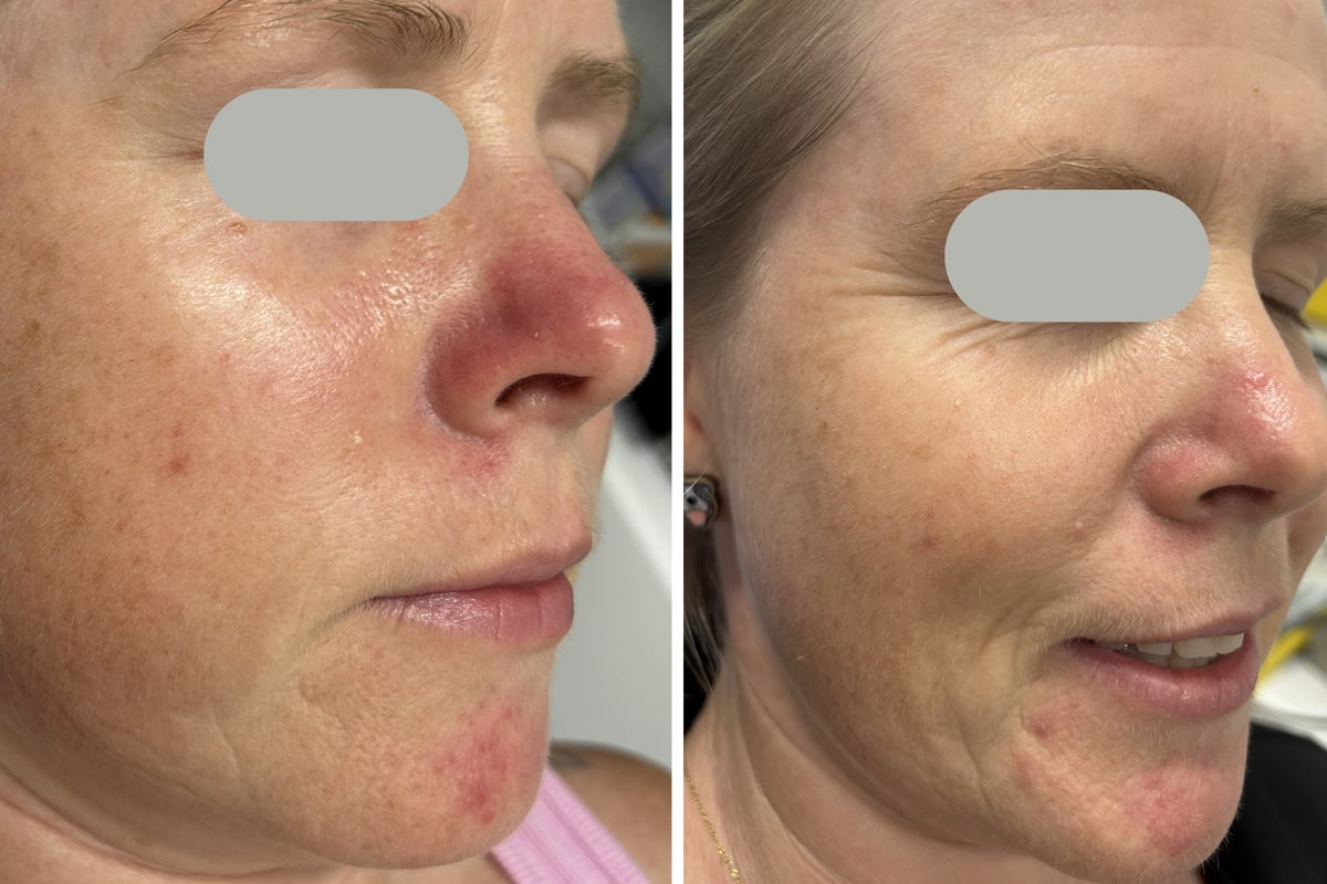 Before and after Dual Yellow laser treatment for rosacea — nose and chin redness cleared